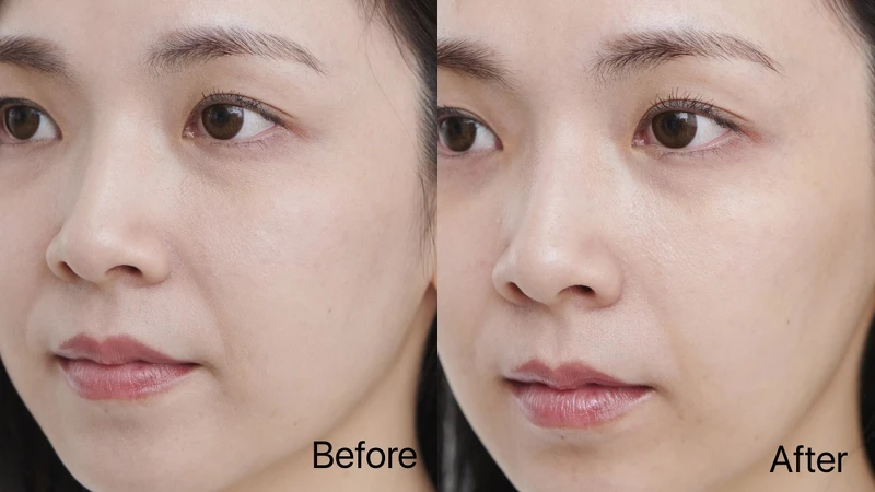 Before:雙下巴明顯,臉周鬆垮 / After:緊實上提,下巴輪廓明顯 Before:雙下巴明顯,臉周鬆垮 / After:緊實上提,下巴輪廓明顯