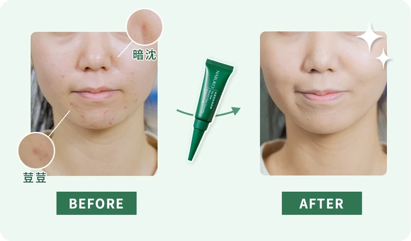 NARUKO茶樹荳荳遮瑕膏使用示意。