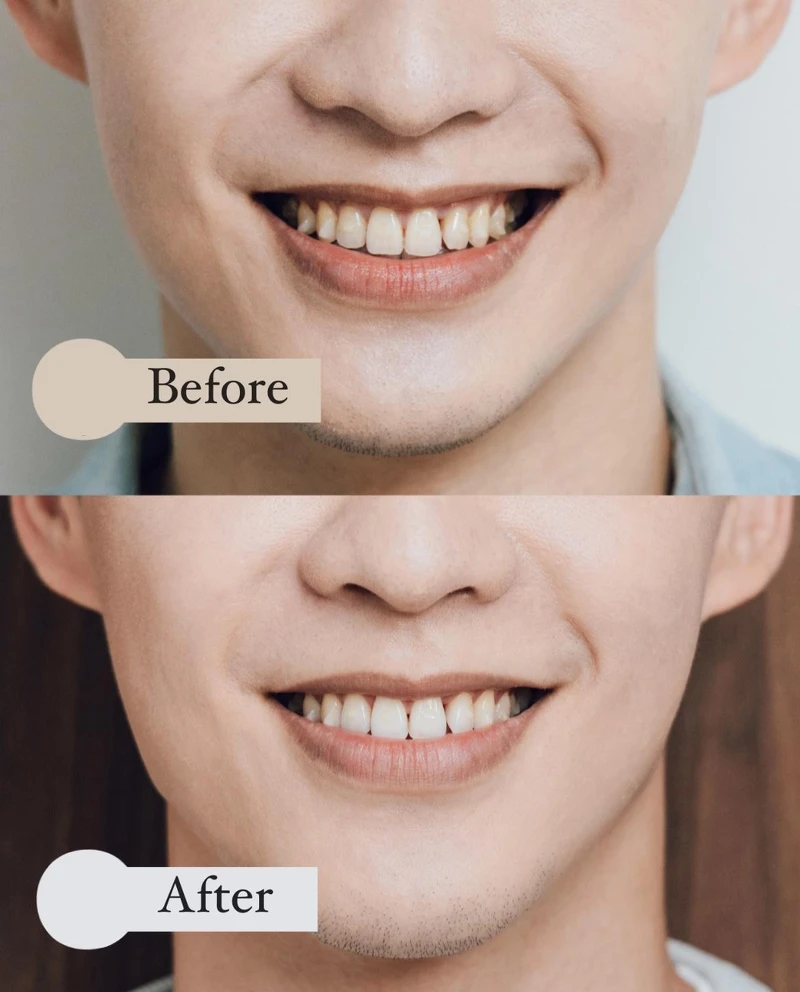 飛利浦Sonicare音波牙刷,使用前vs.使用後,以「音波流體潔力」有效去除牙菌斑和牙漬,深入清潔一般手動牙刷/旋轉式電動牙刷清不到的地方,預防蛀牙和牙結石,一週亮白兩色階。圖/牙醫師炫晨提供 飛利浦Sonicare音波牙刷,使用前vs.使用後,以「音波流體潔力」有效去除牙菌斑和牙漬,深入清潔一般手動牙刷/旋轉式電動牙刷清不到的地方,預防蛀牙和牙結石,一週亮白兩色階。圖/牙醫師炫晨提供