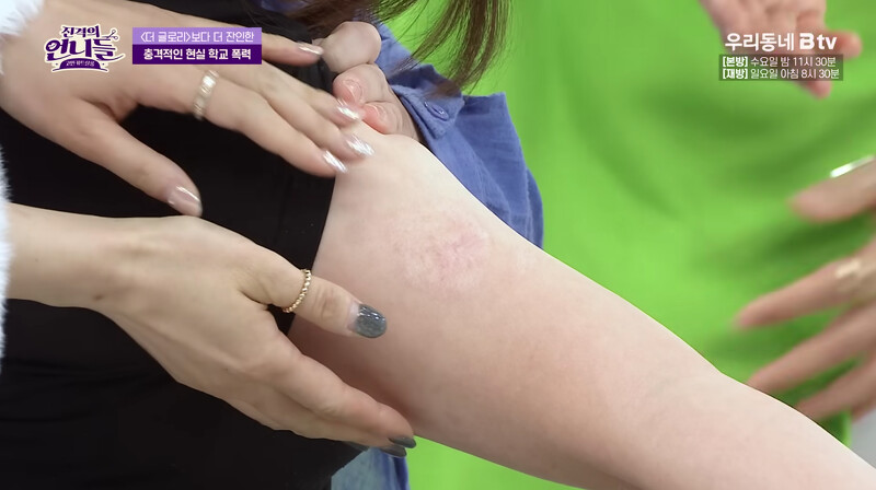 朴成敏害怕傷疤被看見總穿長袖