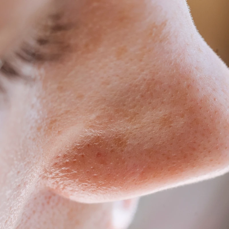 很多人對膚質不滿意的主因都是因為「毛孔粗大」。 很多人對膚質不滿意的主因都是因為「毛孔粗大」。