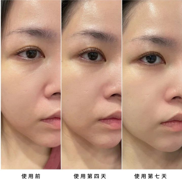 網友曬出BA照,直呼【黑曜岩新生奇蹟高效眼活萃】是紋路剋星 網友曬出BA照,直呼【黑曜岩新生奇蹟高效眼活萃】是紋路剋星