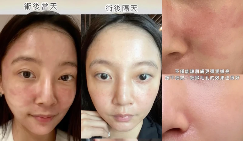 左圖上可見科學美容當天肌膚大範圍泛紅;右邊的肌膚擦上小黑瓶PRO後泛紅面積減少,且膚況更細緻。圖片來源@dolly617wa  左圖上可見科學美容當天肌膚大範圍泛紅;右邊的肌膚擦上小黑瓶PRO後泛紅面積減少,且膚況更細緻。圖片來源@dolly617wa