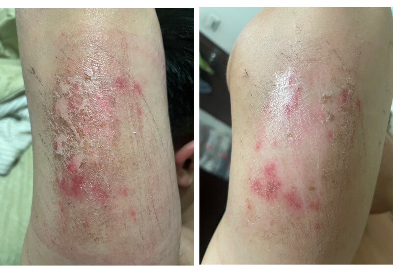 左 : 手臂擦傷未使用#28膠原霜前,右 : 手臂擦傷使用#28膠原霜後 左 : 手臂擦傷未使用#28膠原霜前,右 : 手臂擦傷使用#28膠原霜後