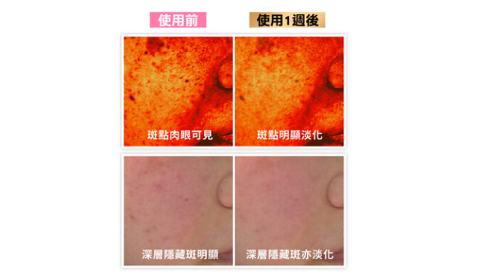 皮膚科醫師親測！五大類型表層斑點、深層隱藏斑點都能通通KO！
