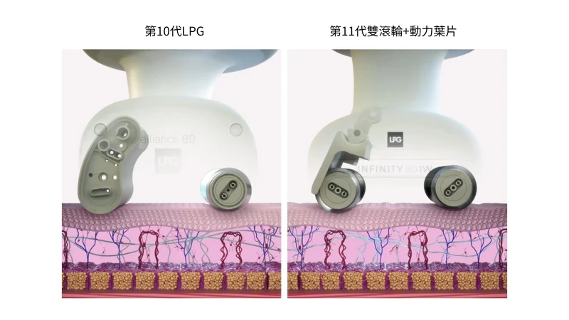 第11代LPG『無限∞』智能探頭升級為雙滾輪+葉片設計 第11代LPG『無限∞』智能探頭升級為雙滾輪+葉片設計