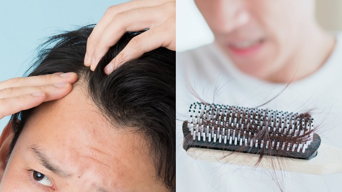 髮際線後退老10歲！皮膚科醫生揭露4大錯誤觀念，解除頭皮危機，髮量關鍵在「這一步」！