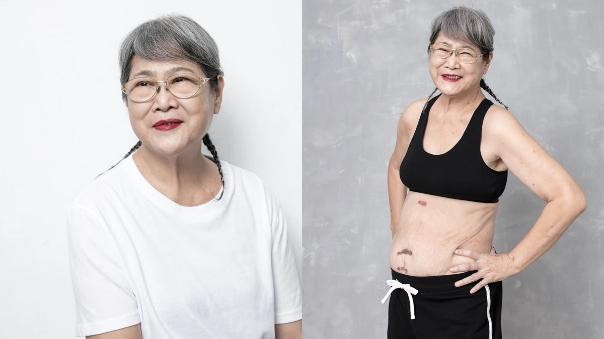 疤痕是好朋友!張智美:「人真的要快樂,不能憂傷,身體才會健康。」
