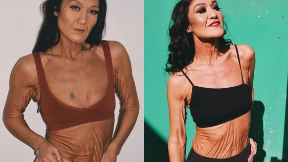 26歲卻全身皮膚鬆垮垮，Sara Geurts：「這就是我，我覺得很美。」