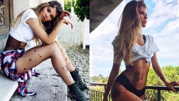  天生黑痣佈滿全身，不被歧視打敗，Yulianna：「獨特性讓我們成為獨一無二的人。」