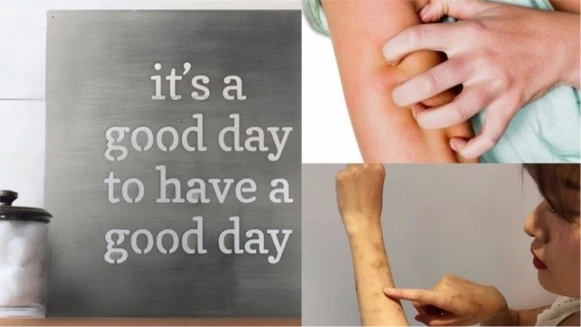 與蕁麻疹同行〜妳可以這麼做！M編跟大家站在同陣線努力ing，讓我們一起揮別癢癢人！