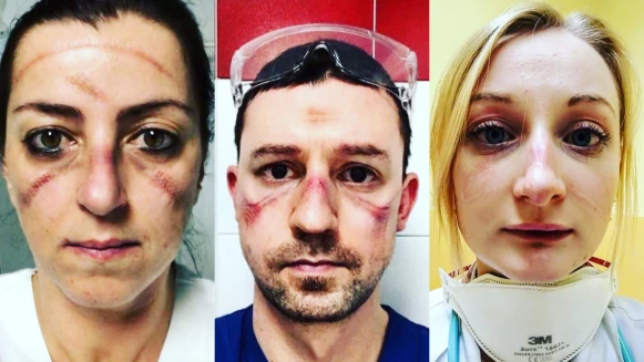 向全球第一線醫護人員致敬！拿掉口罩、護具後臉上的壓痕讓人心疼，是最美麗的抗疫印記