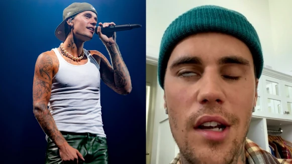 小賈斯汀Justin Bieber罹患罕見疾病面癱!曝右臉不能動,什麼是侖謝亨特氏症候群?