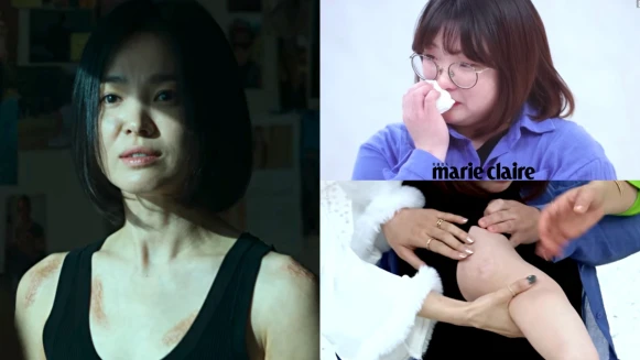 《黑暗榮耀》真實版文同珢現身說法!電捲棒不是最慘,虹膜撕裂、2級燙傷留疤!「去髮廊看到電捲棒都會抖」