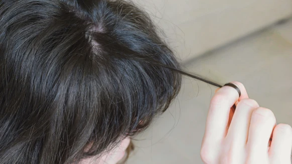 常常有意或無意的拉扯頭髮？有可能患了拔毛症！4個控制情緒技巧+皮膚科醫師髮肌養護秘訣分享！