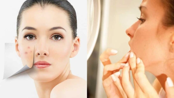 可惡想擠！看到這樣的痘痘，你忍得住嗎？