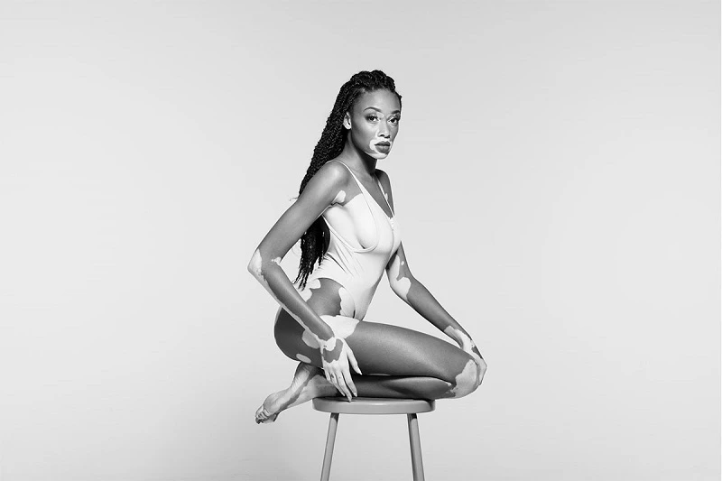 ANTM之後，白斑女模Winnie Harlow專訪 ：｢我只在乎自己的眼光｣