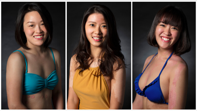 終於不用遮遮掩掩!穿上泳衣,乾癬患者的無懼宣言