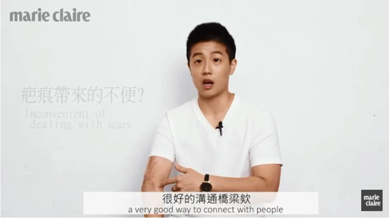 疤痕讓我獨一無二！周旻琦，「活到30歲，終於開始喜歡我的身體。」Behind The Scars-Mickey Chou