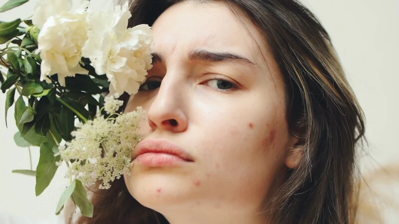 治療痘痘不失靈，５大青春痘疑問解答